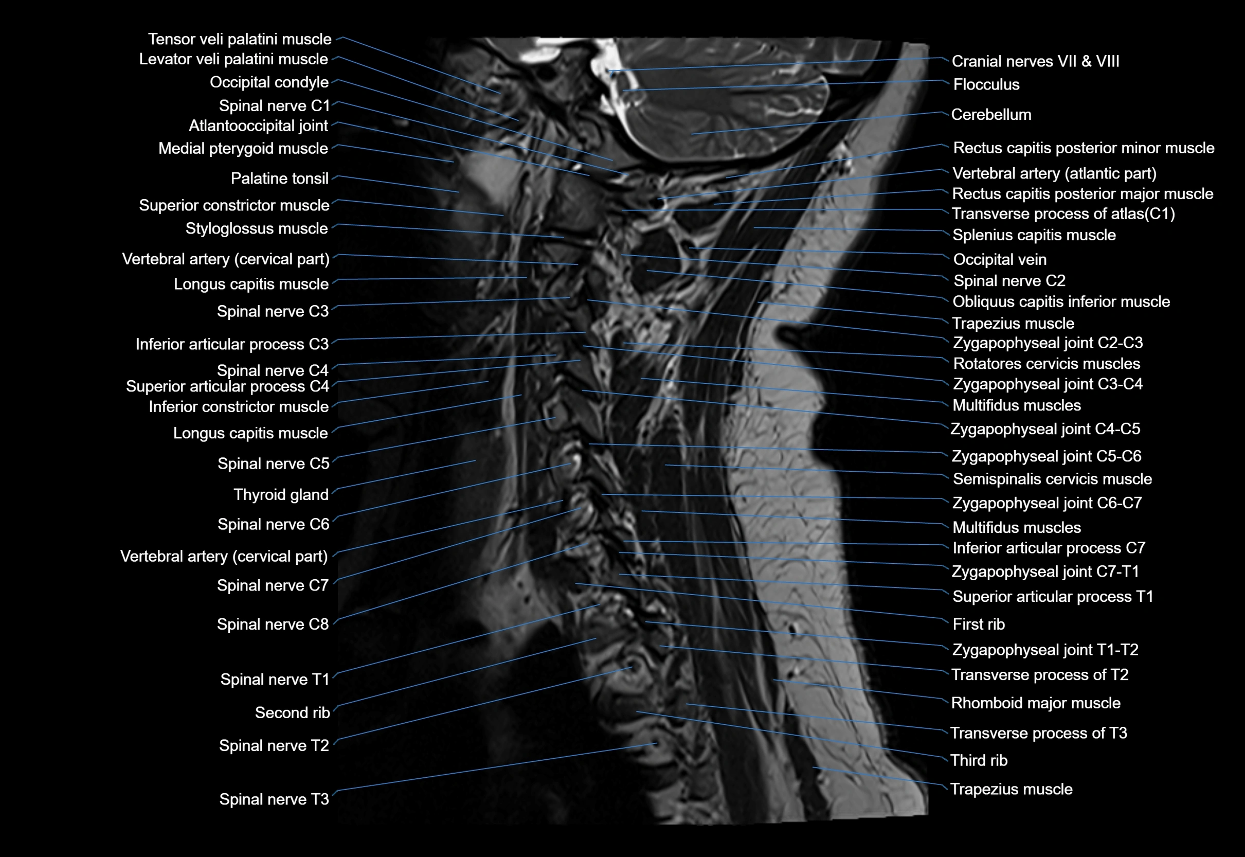 cervical spine cross sectional MRI anatomy 3T MRI  sagittal image-img-00001-00008.webp